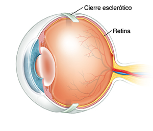 Vista de tres cuartos del corte transversal de un ojo donde puede verse un anillo escleral alrededor de la parte externa del globo ocular.