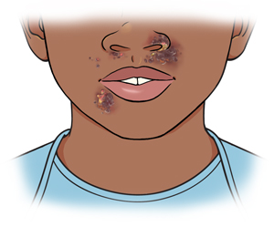 Primer plano de una boca en donde se ven llagas cerca de los labios y alrededor de la nariz.