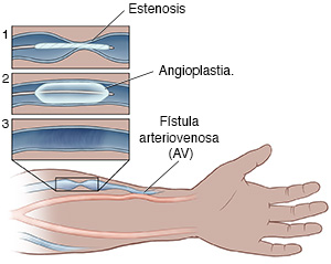 Antebrazo y mano con una vena reducida conectada a una arteria usada para la diálisis. Recuadro donde se observan los pasos de una angioplastia para la reparación de la vena.