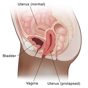 Seccion transversal de vista lateral de la pelvis femenina que muestra un útero prolapsado.