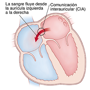 Corte transversal visto de frente de un corazon en donde se ve una comunicación interauricular