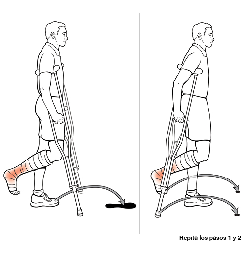 Dos pasos para realizar la técnica pendular con muletas (sin soporte de peso).