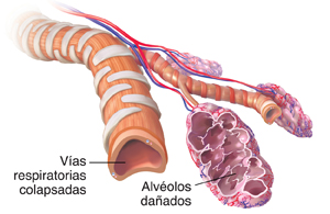 Bronquiolos y alvéolos colapsados con enfisema.