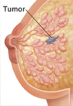 Corte transversal de una mama donde puede verse cáncer de mama invasivo.
