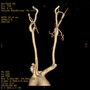 Angiograma por tomografía computarizada de las arterias carótidas.