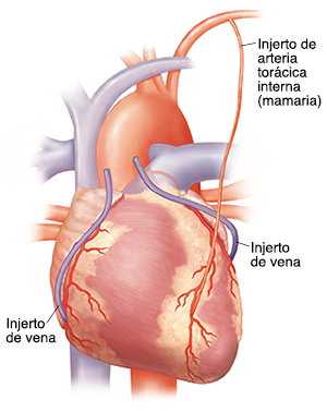 Vista delantera del corazón con tres injertos de derivación (bypass).