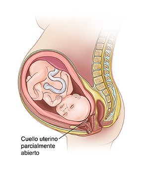 Vista lateral de un feto dentro del útero donde se ve que el cuello uterino comienza a perder espesor y a dilatarse en el trabajo.