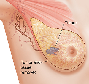Vista de tres cuartos de la zona de una axila femenina donde puede verse la anatomía de la mama en imagen fantasma. Se ve el contorno alrededor del tejido para una mastectomía simple.
