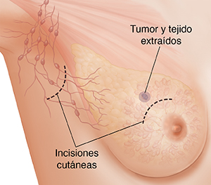 Vista de tres cuartos de la zona de una axila femenina donde puede verse la anatomía del seno en imagen fantasma. Se ven incisiones en la axila y el seno para una tumorectomía.