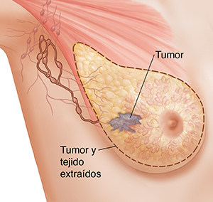 Vista de tres cuartos de la zona de una axila femenina donde puede verse la anatomía del seno en imagen fantasma. Una línea punteada muestra el tejido y los ganglios linfáticos que se extirparon en una mastectomía radical modificada.