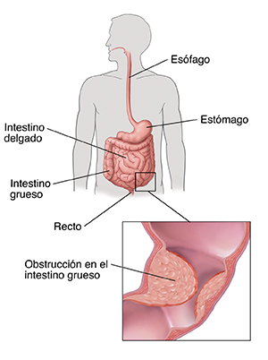 Contorno de una figura humana que muestra el tubo digestivo, donde se destacan el esófago, el intestino delgado, el intestino grueso y el recto. Se observa en detalle la obstrucción en el interior del intestino grueso.