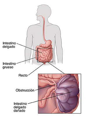 Contorno de una figura humana que muestra el tubo digestivo, donde se destacan el intestino delgado, el intestino grueso y el recto. Detalle de la obstrucción bloqueando el intestino delgado. El intestino bloqueado está dañado.