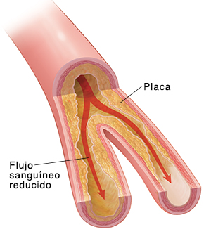 Corte transversal de una arteria en donde se ve placa acumulada en la pared de la arteria y restricción en el paso de la sangre.