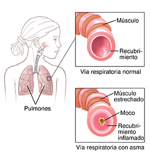 Contorno de una niña donde puede verse el sistema respiratorio. Los recuadros muestran una vía respiratoria normal y una vía respiratoria con asma.