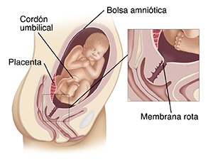 Corte transversal de la pelvis de una mujer embarazada donde se observa al bebé en el saco amniótico en el útero. En el recuadro se observa una rotura en el saco amniótico.