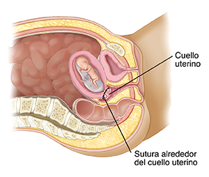 Corte transversal visto de lado de la pelvis de una mujer en donde se ve un bebé en desarrollo en el útero. Una línea muestra en dónde se colocan las suturas para mantener cerrado el cuello uterino.