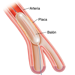 Corte transversal de una arteria con placa en la que puede verse una angioplastia con balón.