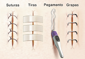Cuatro incisiones donde se observa cierres con suturas, con tiras para cierres de heridas, con pegamento quirúrgico y con grapas.