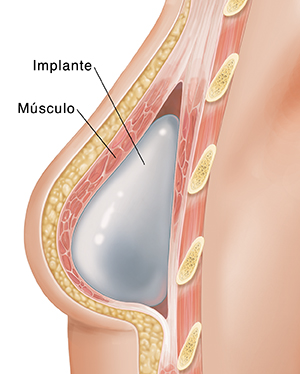 Corte transversal de un seno donde puede verse un implante después de una mastectomía.