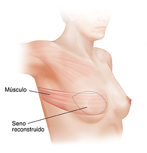 Vista lateral del tórax femenino donde puede verse una reconstrucción mamaria con colgajo LD.