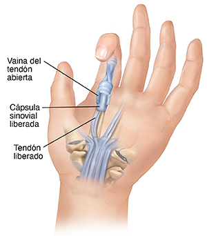 Vista de la palma de una mano donde se observa cirugía en el tendón y la cápsula sinovial para liberar un dedo en resorte.