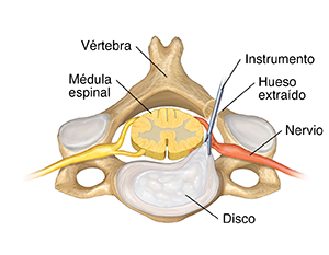 Vista superior de una vértebra cervical y de un disco con un instrumento retirando el disco de la parte anterior.