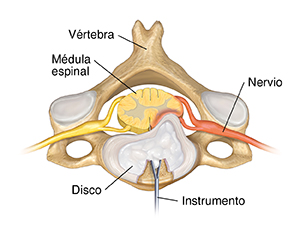 Vista superior de una vértebra cervical y de un disco con un instrumento retirando el disco de la parte posterior.
