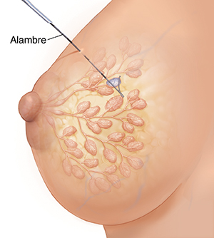 Vista lateral de un seno femenino donde pueden verse los conductos y los lóbulos en imagen fantasma. Se muestra un alambre que atraviesa la piel y llega hasta el bulto.