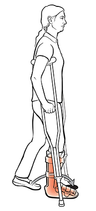 Vista lateral de una mujer con muletas que avanza hacia delante con el pie sano, entre las muletas.