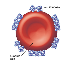 Glóbulos rojos con muchas moléculas de glucosa pegadas.
