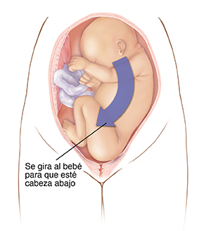 Vista frontal de un bebé dentro del útero con la cabeza hacia arriba. Flecha que indica que el bebé debe estar con la cabeza hacia abajo para el parto.