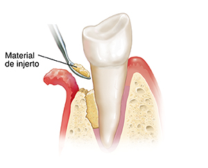 Diente en corte transversal del hueso y la encía. Colgajo gingival que expone la raíz del diente y el hueso erosionado. Un instrumento coloca material de injerto entre el hueso y el diente.