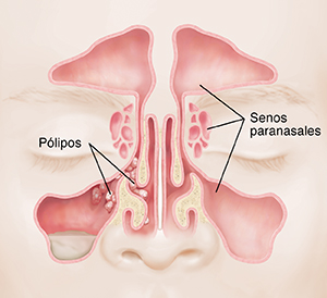 Vista frontal de una cara en la que se ven los senos paranasales con pólipos.