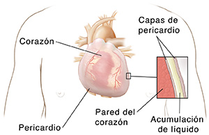 Vista frontal del pecho de un hombre donde pueden verse el corazón y los pulmones con un recuadro que muestra efusión pericárdica.