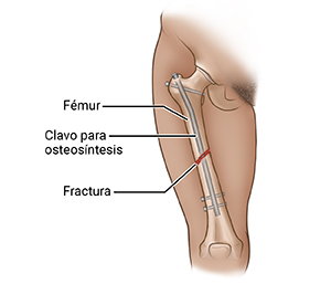 Vista frontal del muslo donde se observa la fractura en el fémur con fijación interna (clavos flexibles).