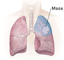 Vista frontal del pecho donde pueden verse los pulmones. La zona sombreada muestra una resección de segmento.