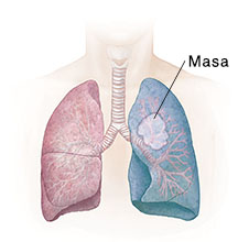 Vista frontal del pecho donde pueden verse los pulmones. La zona sombreada muestra una neumonectomía.