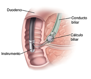 Primer plano del conducto colédoco, del páncreas y del duodeno donde se ve una CPRE.
