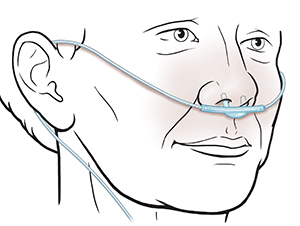Vista de tres cuartos de una cara en la que puede verse la correcta colocación de una cánula nasal.