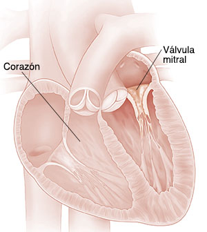 Corte transversal del corazón que muestra una válvula mitral con estenosis. 