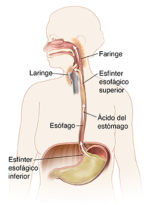 Contorno de una mujer donde pueden verse la boca, el esófago y el estómago. Unas flechas muestran el ácido del estómago que sube al esófago e irrita la parte posterior de la garganta.