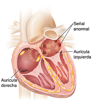 Corte transversal de un corazón con fibrilación auricular.