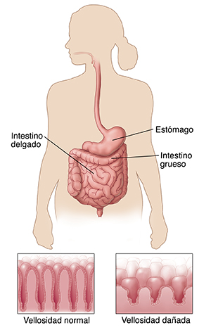 Contorno de una figura humana que muestra el sistema digestivo. El detalle compara las vellosidades normales, en forma de tallos carnosos que recubren el intestino, con las vellosidades dañadas que son más cortas.