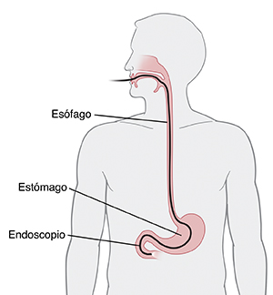 Contorno de la parte superior del cuerpo donde se ve un endoscopio introducido a través de la boca hasta el interior del estómago.