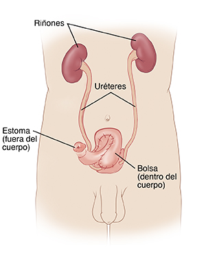 Vista frontal del contorno de un hombre en el que pueden verse los riñones, los uréteres y la neovejiga con un estoma en el exterior del cuerpo.