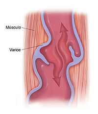 Corte transversal de músculo y vena varicosa con válvula dañada. Las flechas indican el movimiento de la sangre hacia abajo.