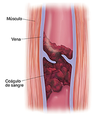 Corte transversal de músculo y vena varicosa con coágulo de sangre.