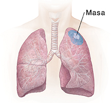 Vista frontal del pecho donde pueden verse los pulmones. La zona sombreada muestra una resección en cuña.