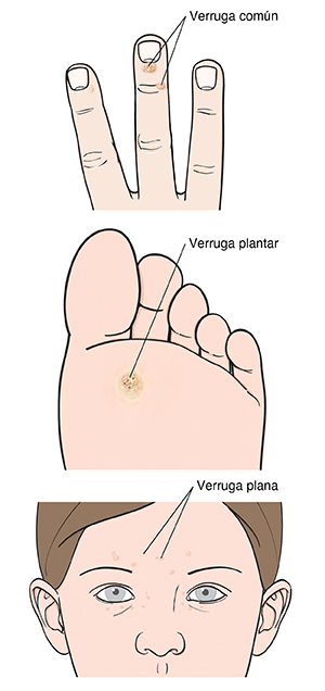Verruga común en el extremo de un dedo de una mano. Verruga plantar en la planta de un pie. Verrugas planas en la cara de una mujer.