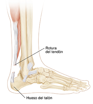 Vista lateral de la parte inferior de la pierna donde pueden verse los huesos y un tendón de Aquiles roto.